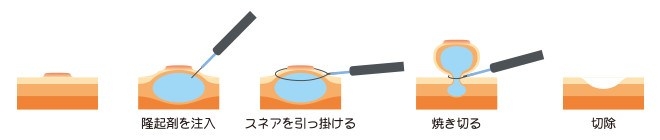 内視鏡的粘膜切除術：EMR