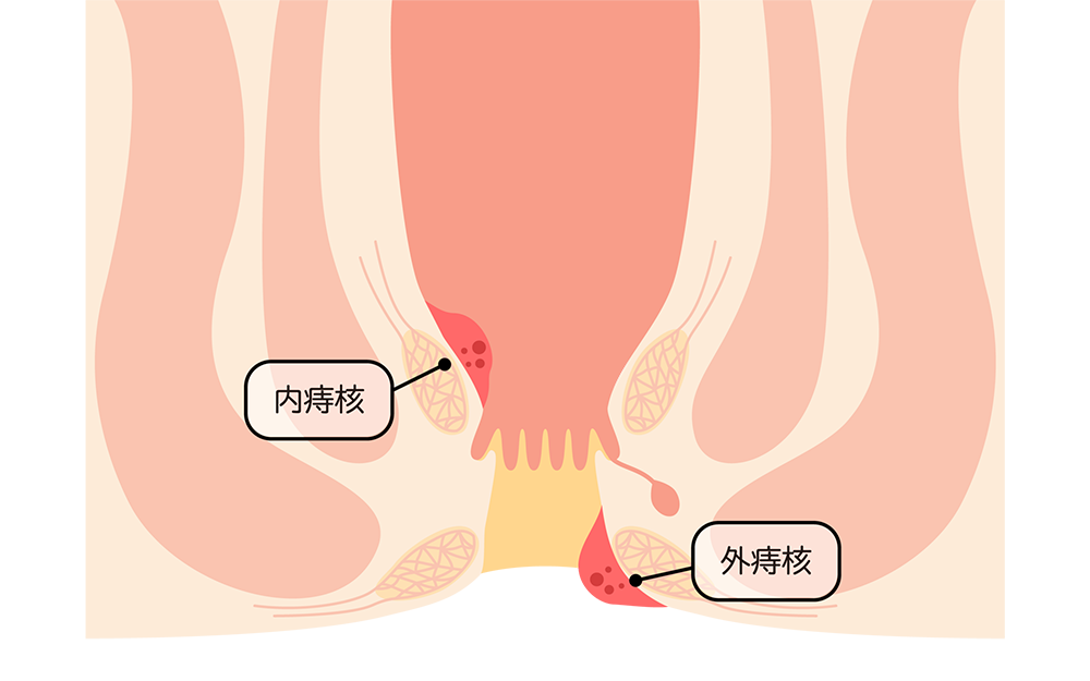 いぼ痔