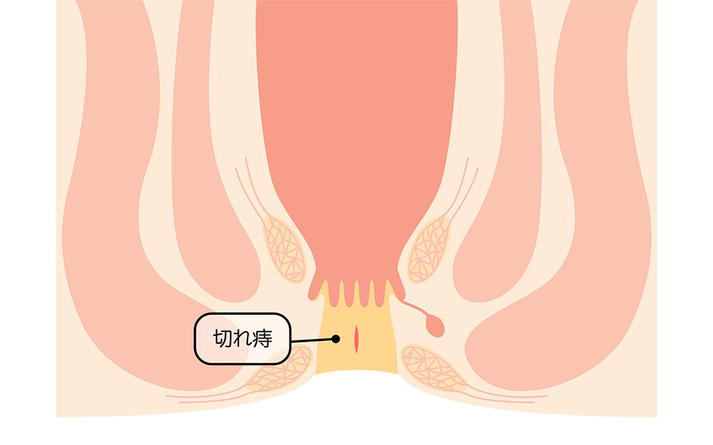 切れ痔（裂肛）