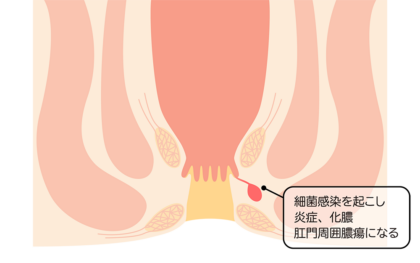 痔ろう（あな痔）と肛門周囲膿瘍