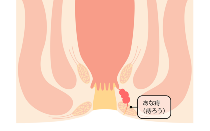 痔ろう（あな痔）と肛門周囲膿瘍