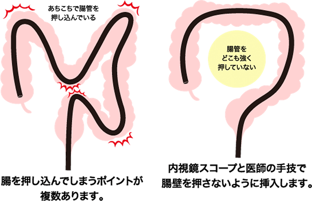 軸保持短縮法